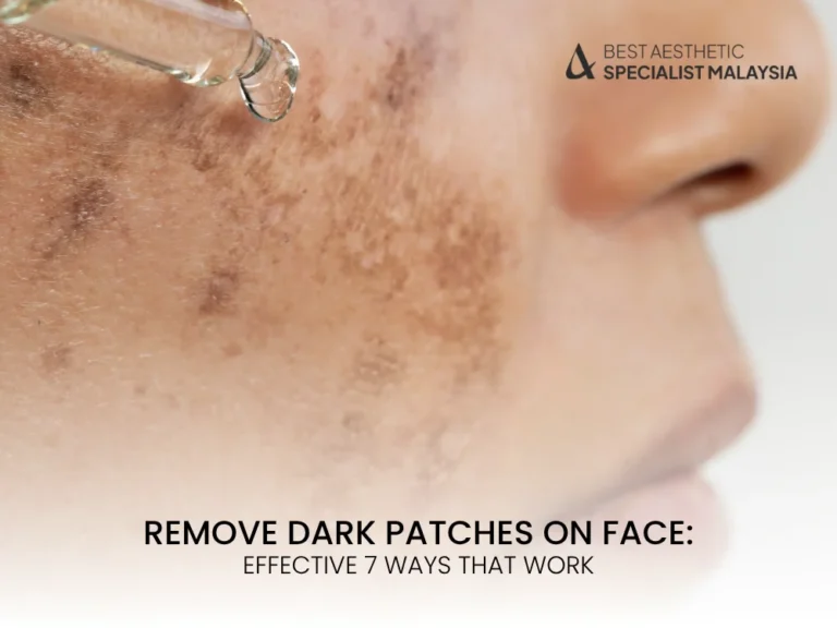 remove-dark-patches-on-face