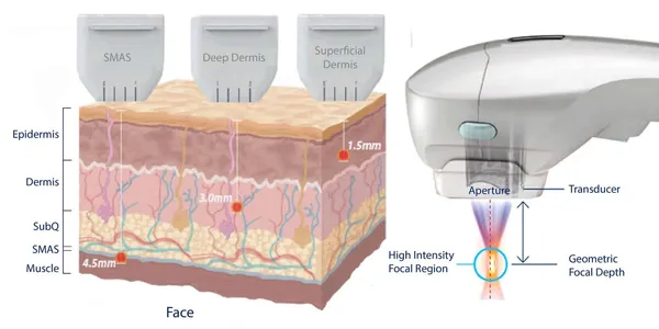 hifu-treatment-malaysia-before-after-skin-lifting
