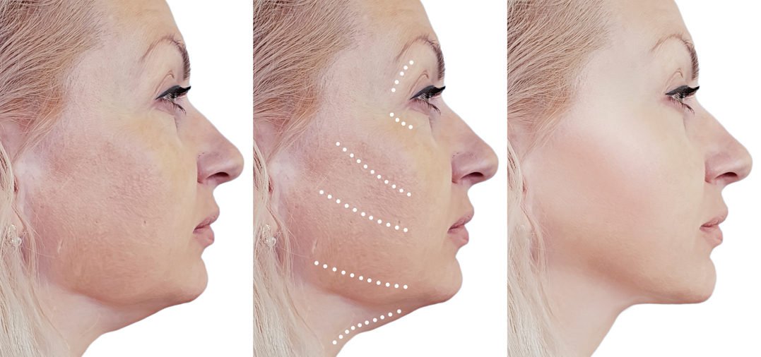 skin-tightening-treatment-malaysia