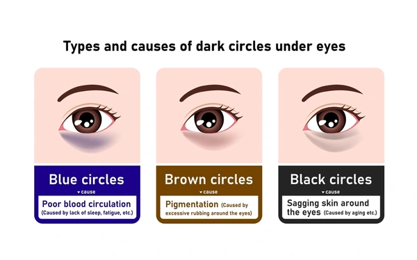 dark-circle-treatment-types-causes
