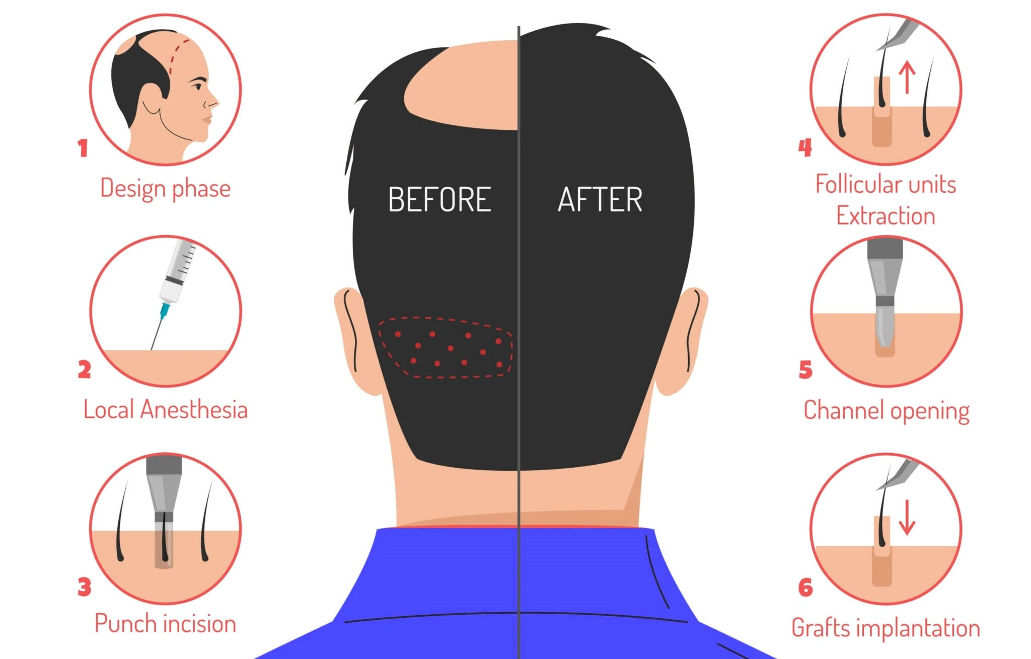 Hair Transplant Cost in Asia: Why Malaysia Is Your Best Choice 1 hair-transplant-cost-malaysia