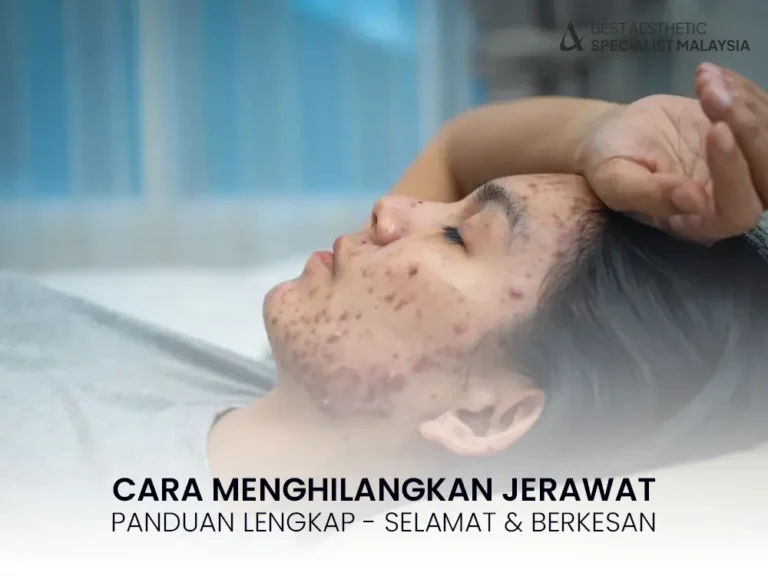 cara-menghilangkan-jerawat