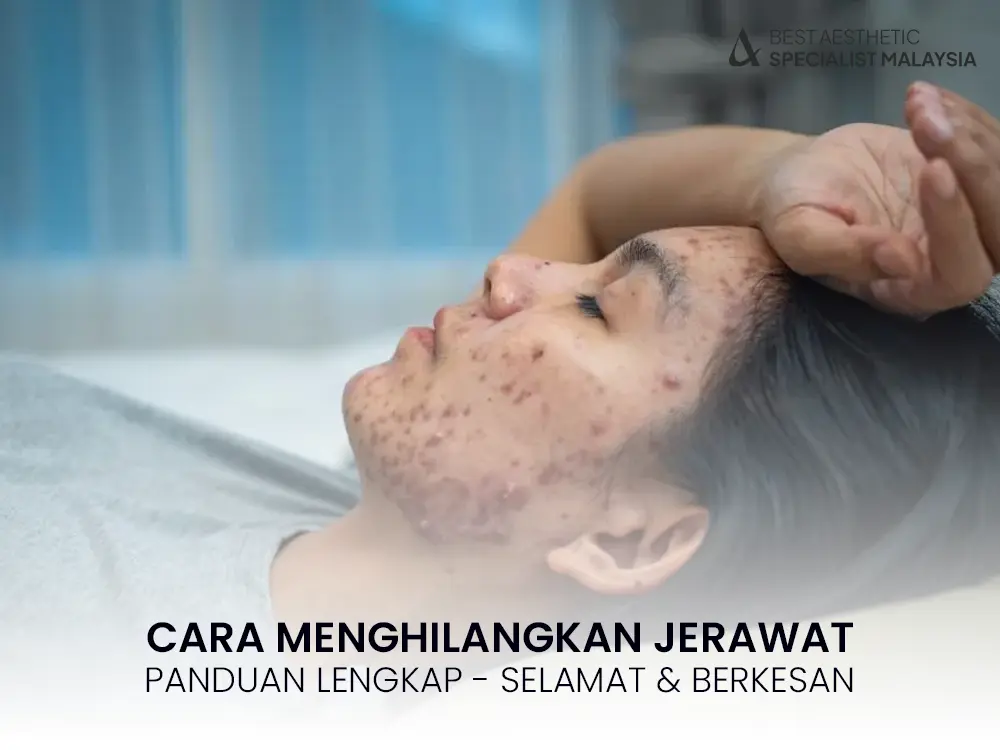 cara-menghilangkan-jerawat