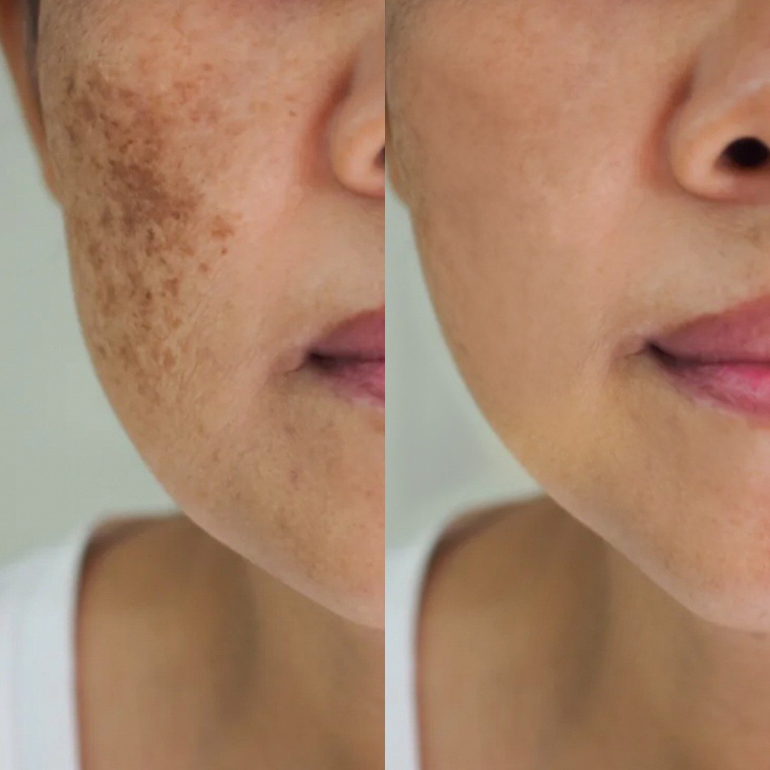 pico-laser-before-after