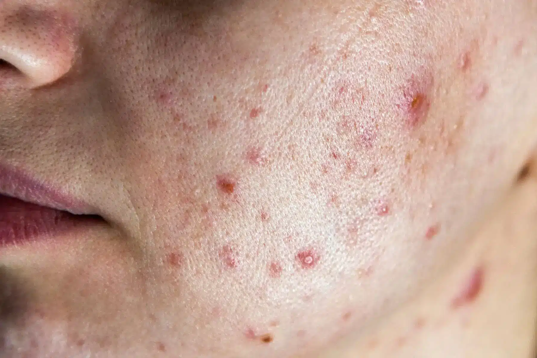 hormonal-acne-malaysia