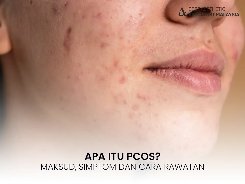 PCOS-maksud-simptom-punca