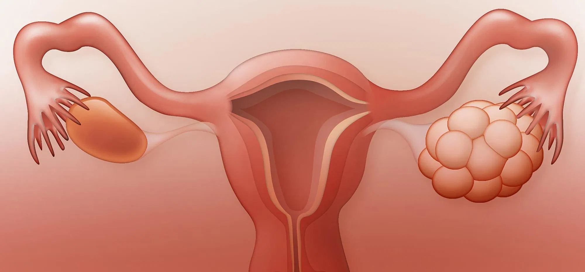 PCOS-maksud