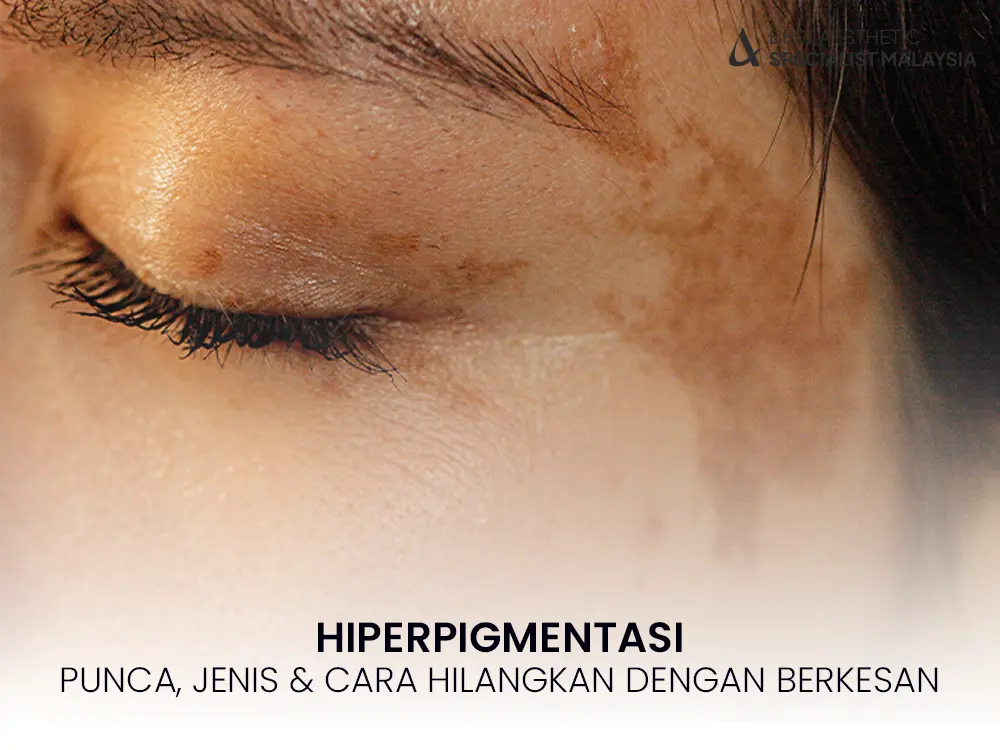 hiperpigmentasi