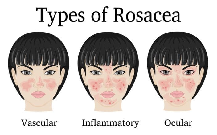 rosacea-yellow-laser
