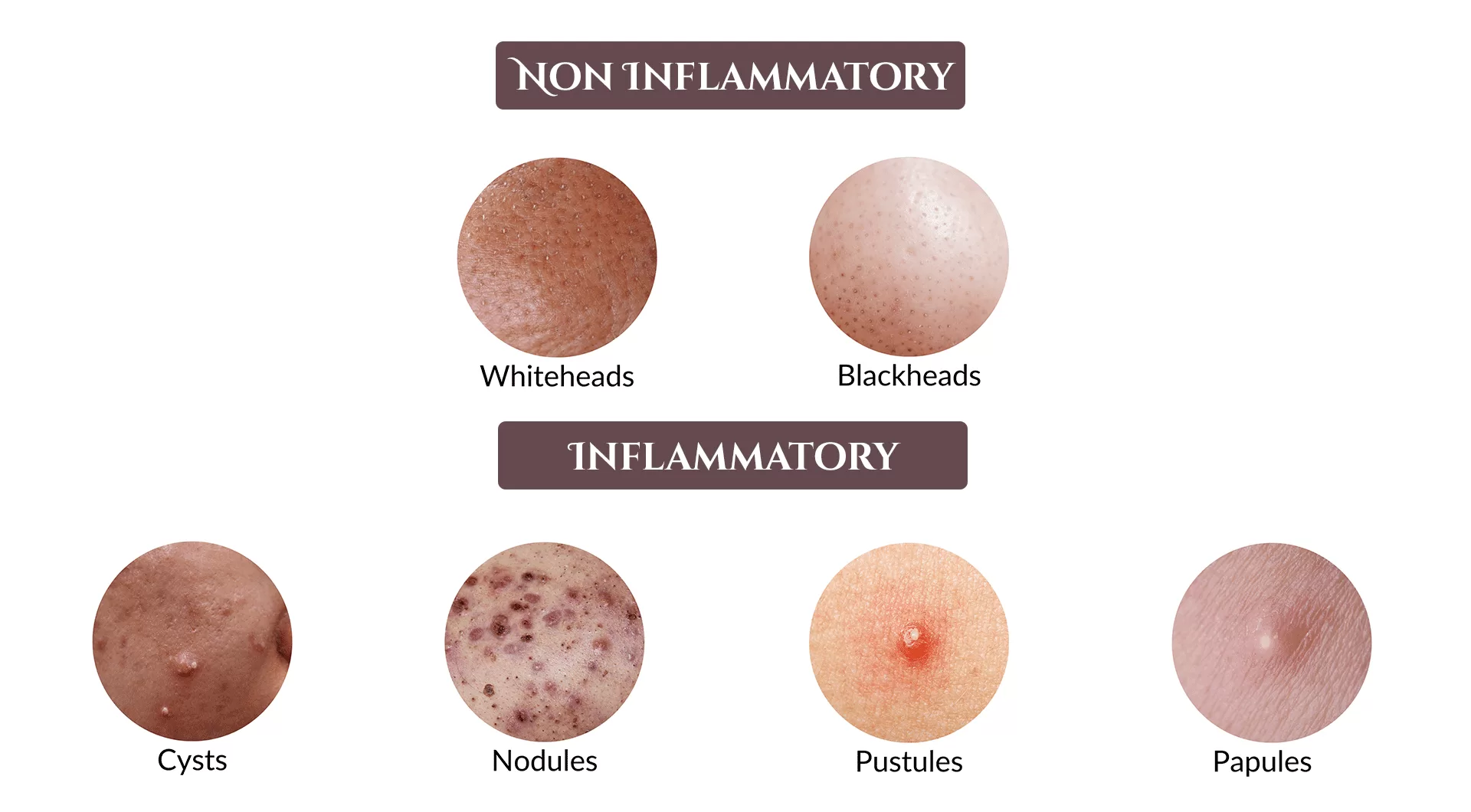 hormonal-acne-malaysia