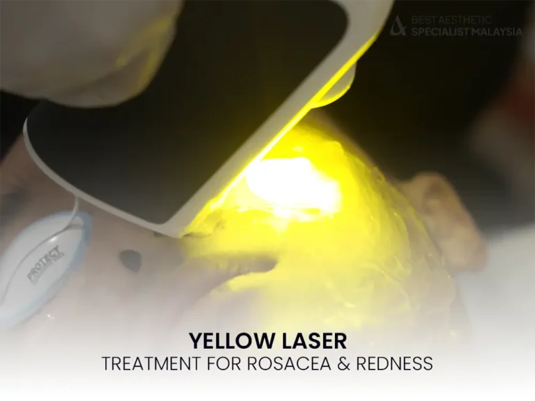 yellow-laser-treatment