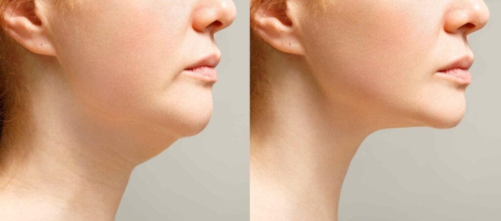 Double-Chin-Treatment
