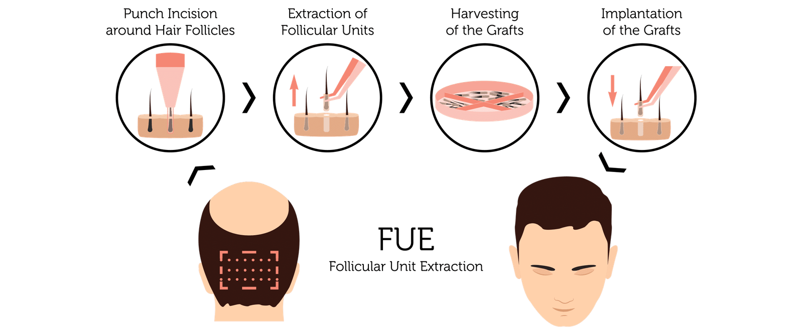 fue-hair-transplant