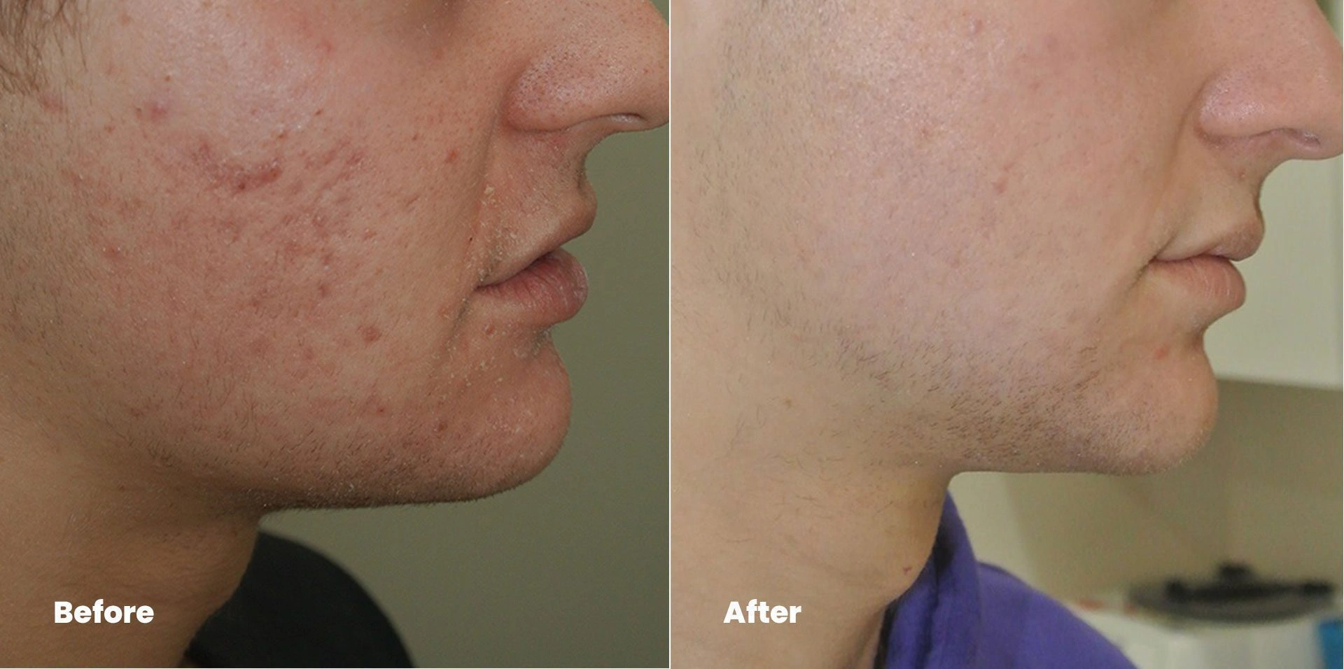 pico-laser-before-after
