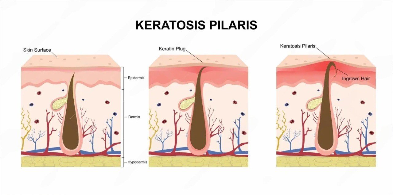 Keratosis pilaris-malaysia