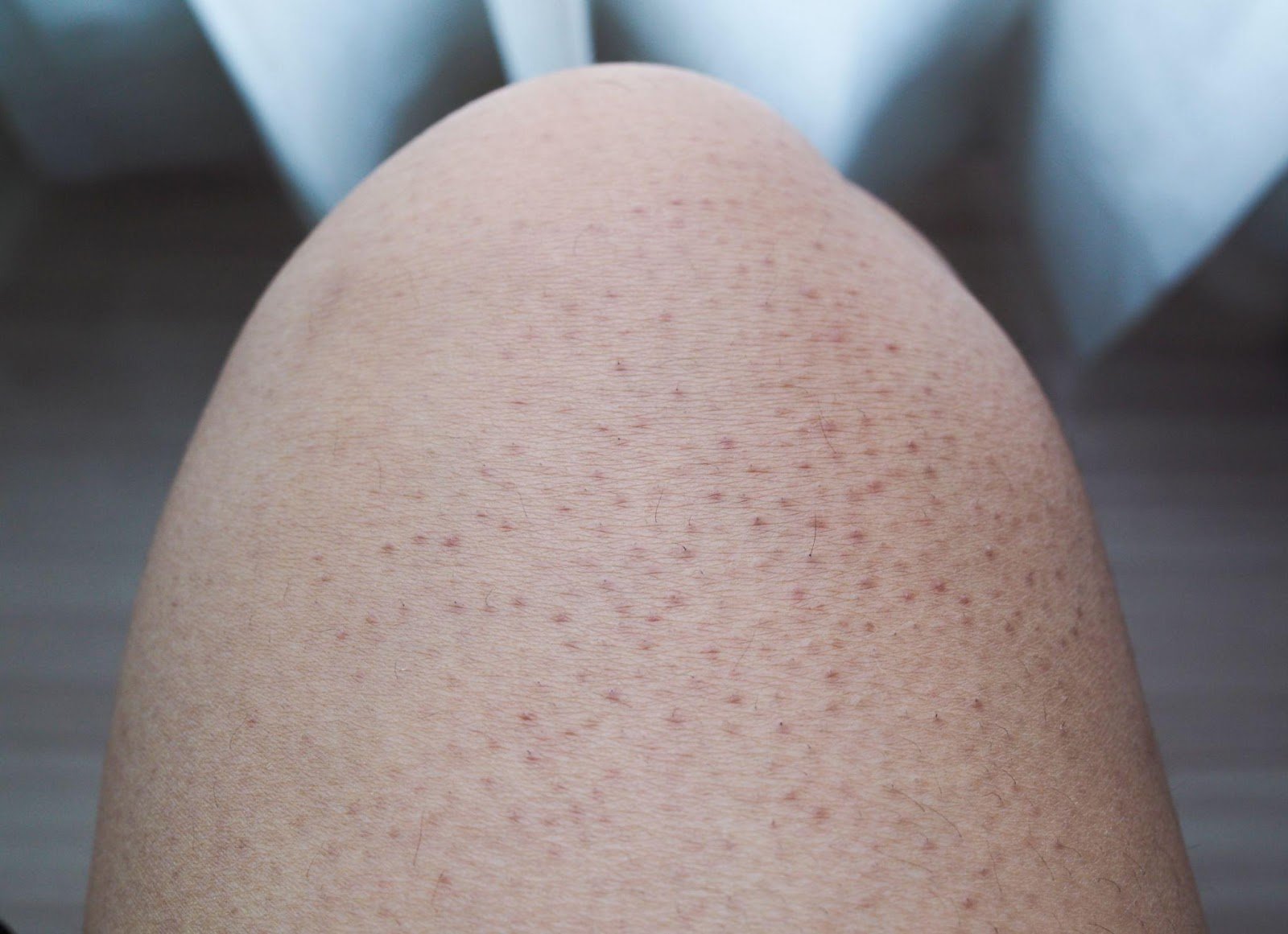 Keratosis pilaris-malaysia