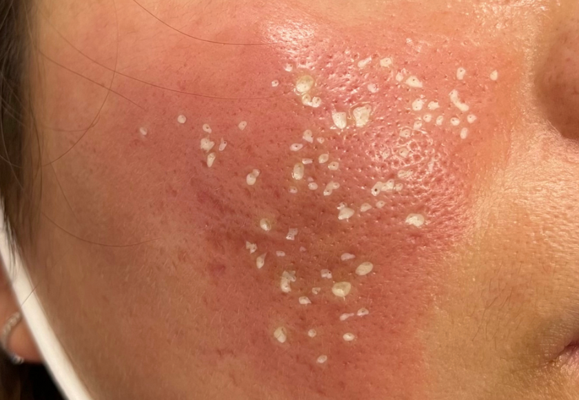 TCA-Cross-Treatment-In-Progress