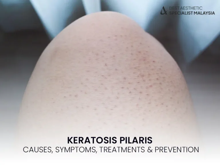 keratosis-pilaris-guide