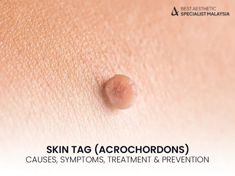 skin-tag