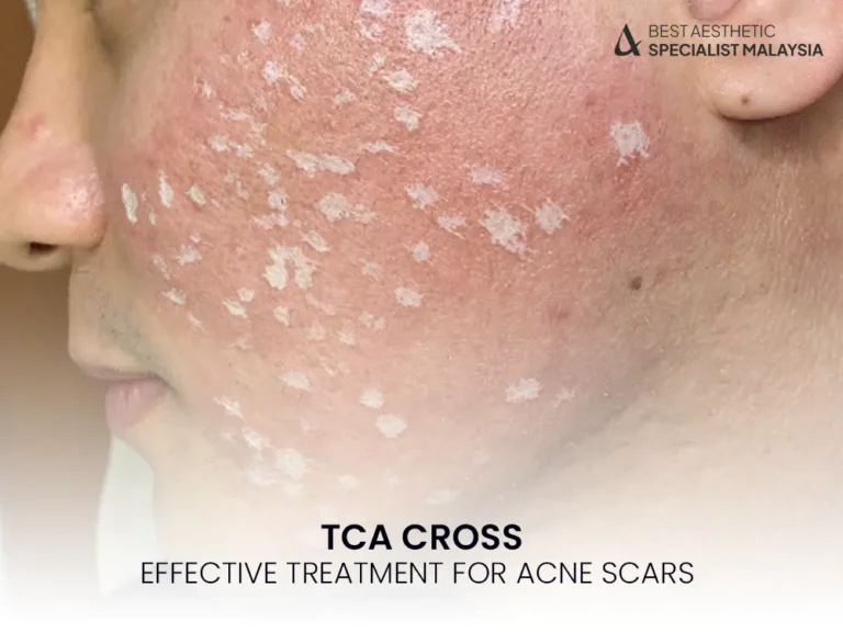 tca-cross-treatment-malaysia