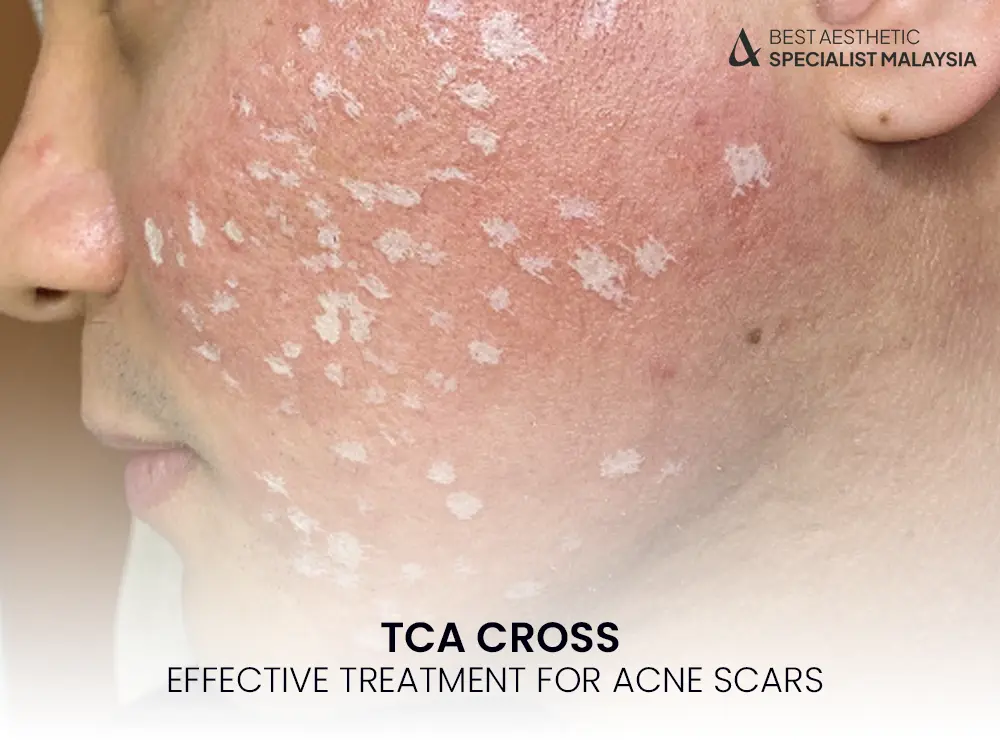 tca-cross-treatment-malaysia