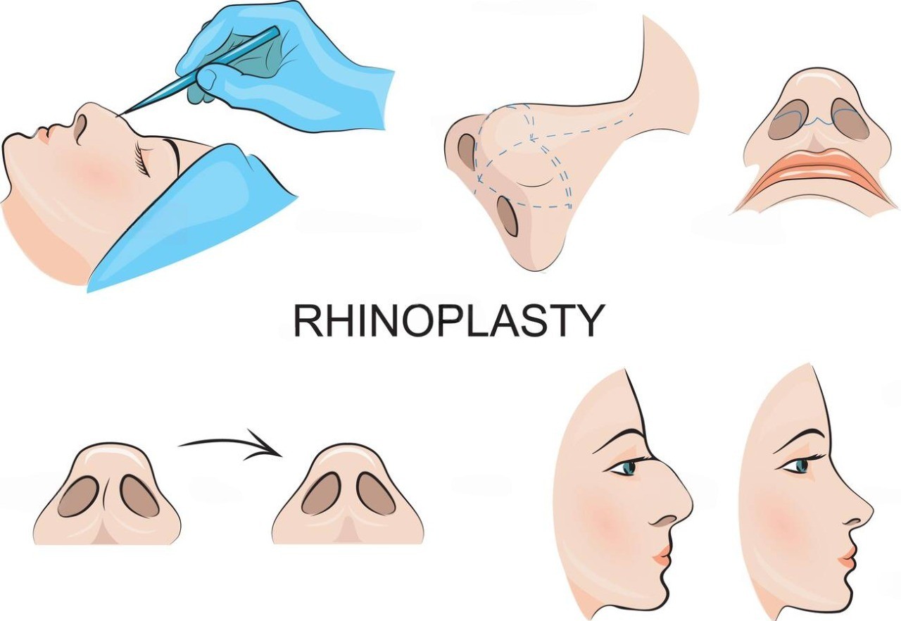 What Is Rhinoplasty Surgery? Understanding Nose Reshaping